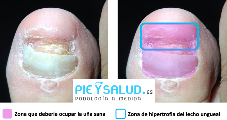 Alteraciones De Las U As Y Su Reconstrucci N Pie Y Salud